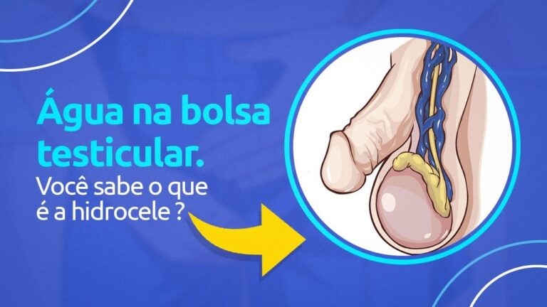 Guia Completo sobre Hidrocele no Testículo