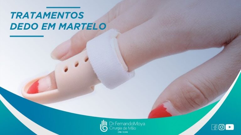 Tratamento de Dedo em Martelo: Papel da Fisioterapia