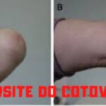 Entendendo o Síndrome Pulmão Rim: Causas e Tratamentos