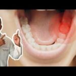 Discopatia Degenerativa Cervical C5-C6: Causas, Sintomas e Tratamentos