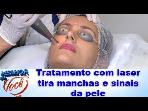 Como remover sinais na pele de forma eficaz