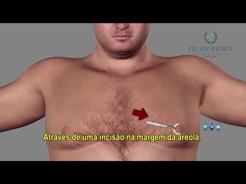 Guia Completo para Mamoplastia Masculina