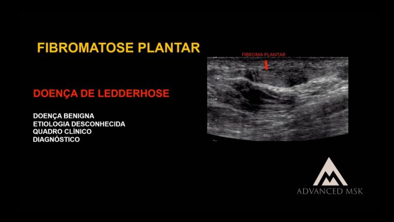 Fibromatose Plantar: Possíveis Tratamentos e Cura