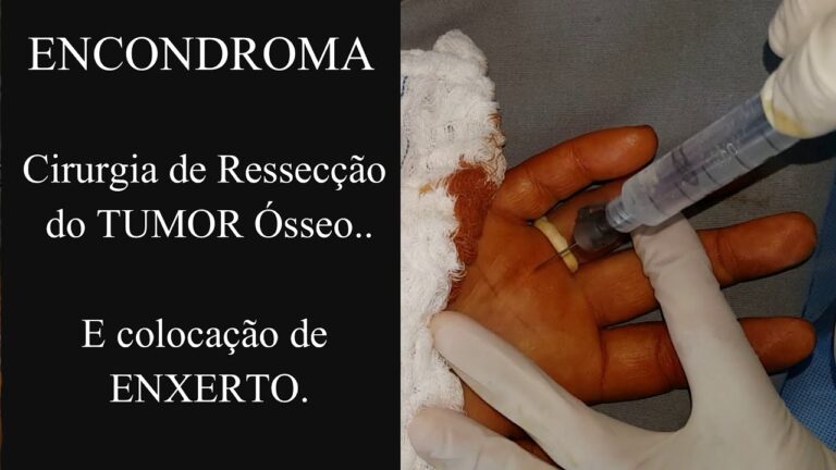 Encondroma: Quando é Necessária a Cirurgia