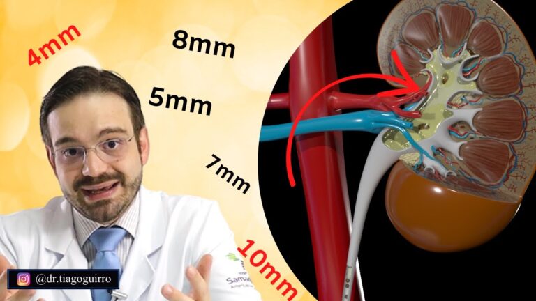 Como expelir pedra no ureter: m&eacute;todos eficazes e naturais