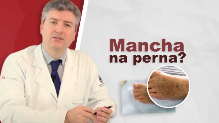Melhor creme para dermatite ocre: Guia de tratamento eficaz