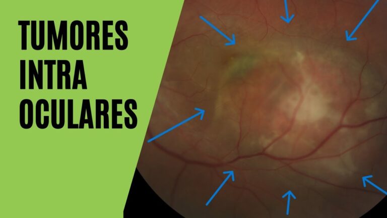 Sintomas de Tumor Atrás do Olho: Guia Completo