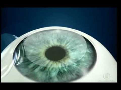 Cirurgia Ocular: Tudo o que Voc&ecirc; Precisa Saber