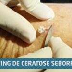 Aorta Ateromatosa: Significado e Implicações