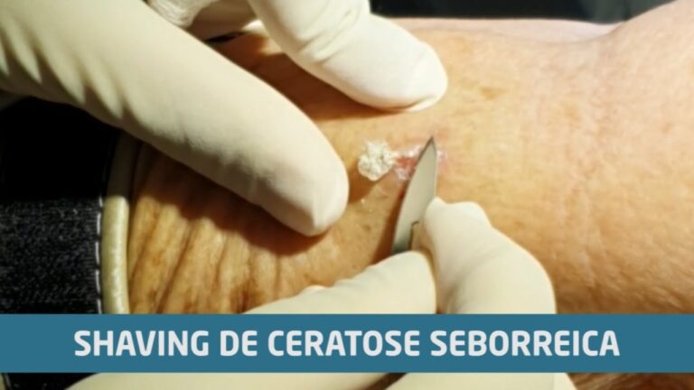 Guia de Shaving Dermatológico: Dicas e Cuidados