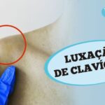 Artrose no Bra&ccedil;o: Causas, Sintomas e Tratamentos