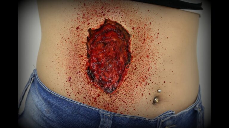 Cirurgia de Barriga Aberta: O que você precisa saber