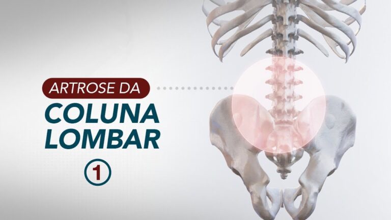 Imagens de Artrose na Coluna Lombar