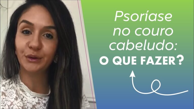 Pitir&iacute;ase do Couro Cabeludo: Causas, Sintomas e Tratamentos