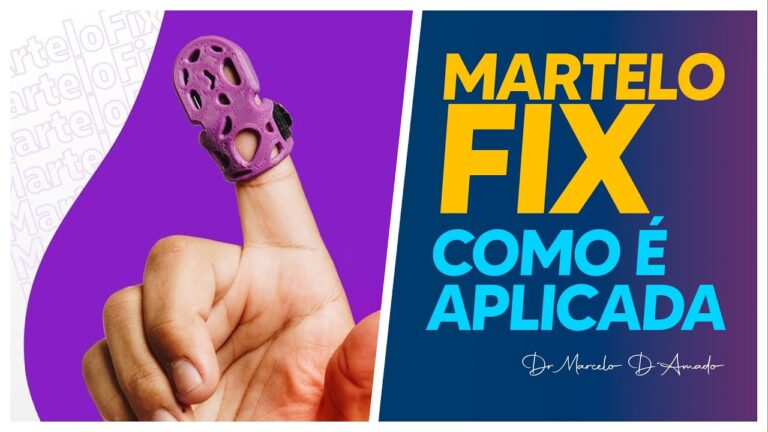 Ortese para Dedo em Martelo: Guia Completo e Recomenda&ccedil;&otilde;es