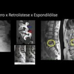 Colocar gelo na coluna cervical: é seguro?