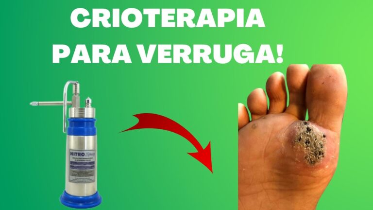 Crioterapia: Resultados Antes e Depois no Tratamento de Verrugas ...