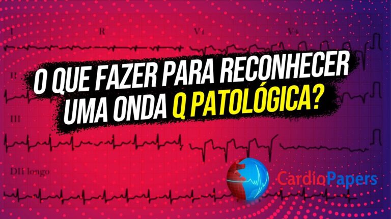 Onda Q: O que é eletrocardiograma