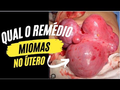 Antiinflamatório eficaz no tratamento de mioma: descubra o indicado