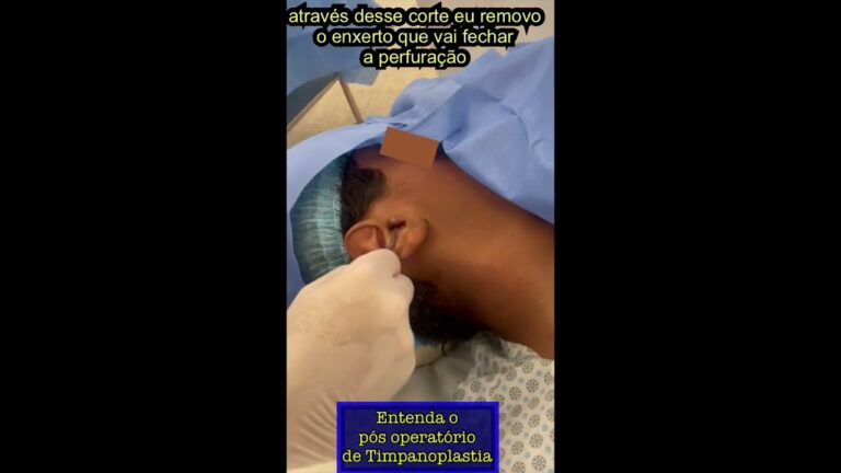 Repouso pós-cirurgia de tímpano perfurado: Guia otimizado