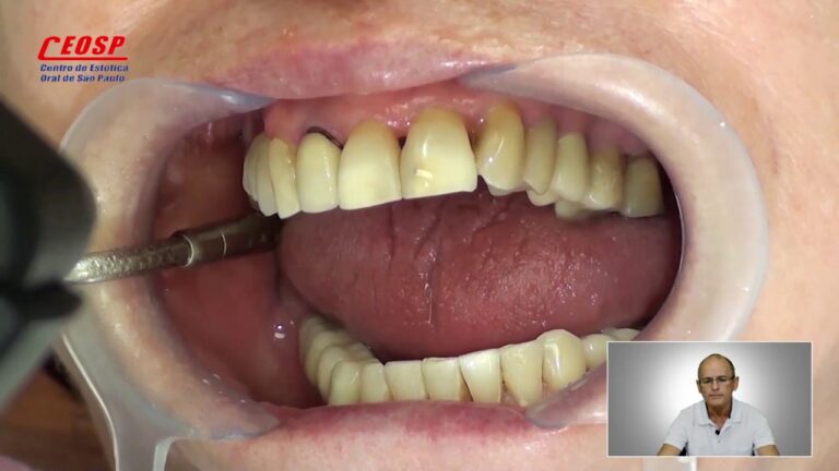 Como evitar o escurecimento dos dentes pr&oacute;ximos &agrave; gengiva