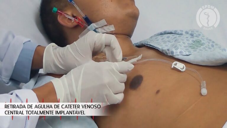 Agulha de Acesso: Guia Completo