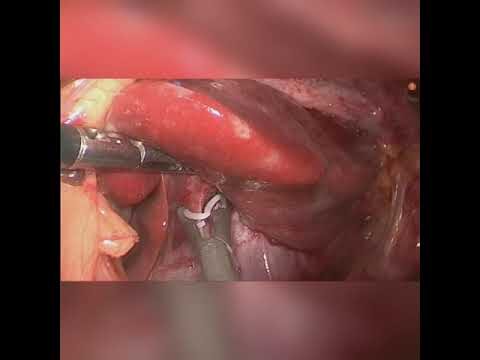 Segmentectomia Hep&aacute;tica: Uma Abordagem Otimizada para Tratamento de Doen&ccedil;as Hep&aacute;ticas