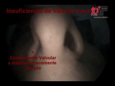 Endoscopia: &Eacute; poss&iacute;vel realizar o procedimento com nariz entupido?