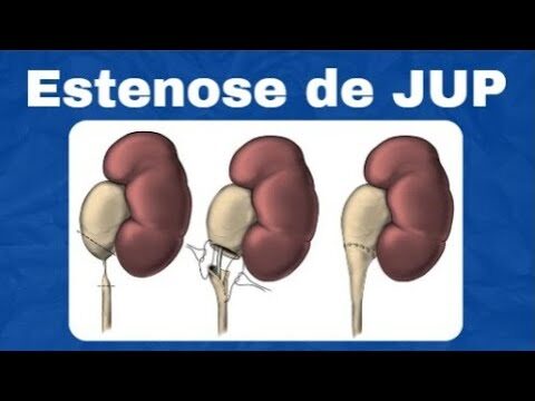 Anatomia e Fun&ccedil;&atilde;o da Jun&ccedil;&atilde;o Ureterop&eacute;lvica