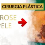 Ginecomastia em Mulheres: Causas, Sintomas e Tratamentos