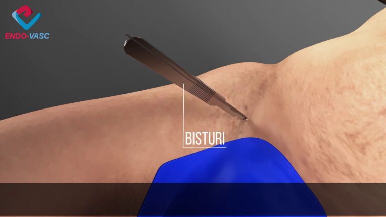Stent na perna: o que você precisa saber