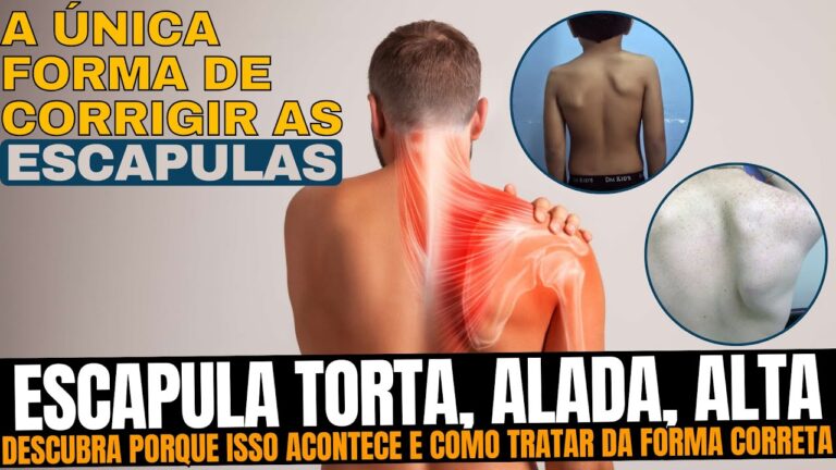 Escápula Alada: Compreendendo a Lesão do Nervo
