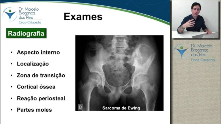 Fotos de Câncer Ósseo: Diagnóstico e Tratamento