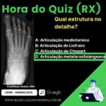 Cirurgia de Hernia Inguinal por Vídeo: Uma Abordagem Otimizada.