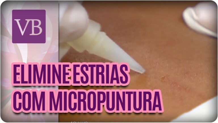 Como tratar estrias hipertróficas: Guia completo