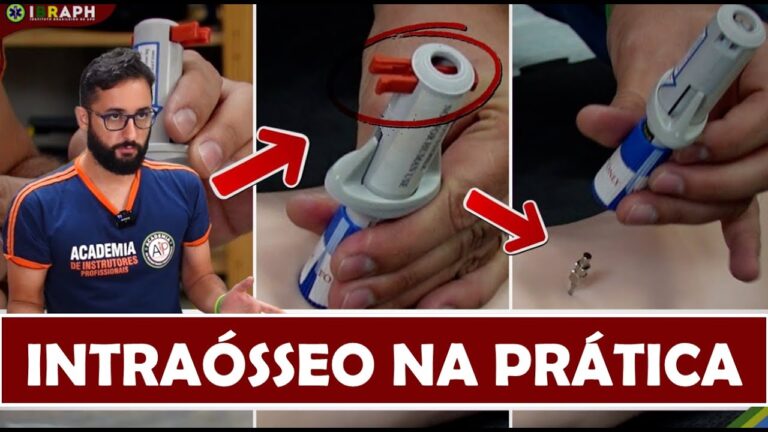 Agulha Intraóssea: Técnica e Aplicações