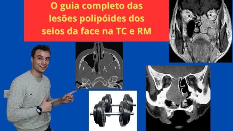 Tomografia nasal para diagn&oacute;stico de p&oacute;lipo nasal: uma revis&atilde;o otimizada