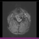Colocar gelo na coluna cervical: é seguro?