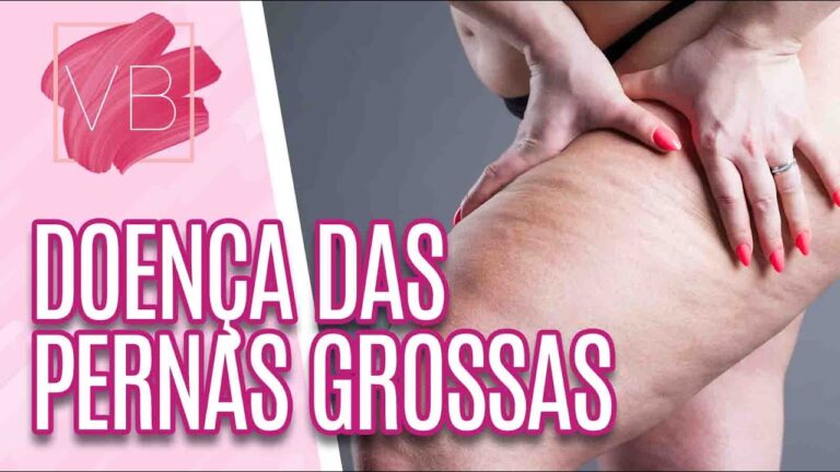 Doença das Pernas Grossas: Causas e Tratamentos
