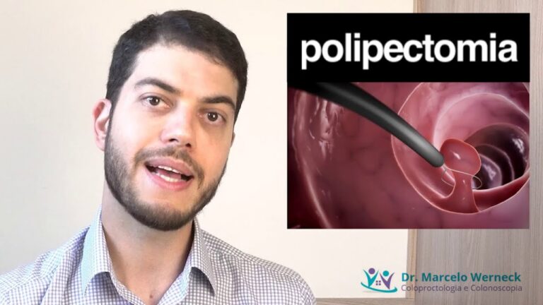 Dura&ccedil;&atilde;o ideal de repouso ap&oacute;s retirada de p&oacute;lipo intestinal