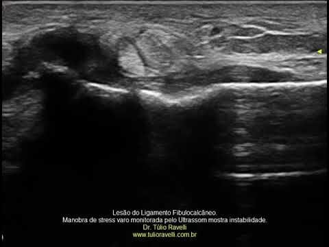 Anatomia e Fun&ccedil;&atilde;o do Ligamento Fibulocalc&acirc;neo