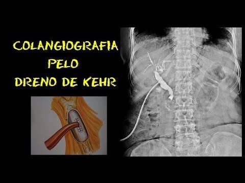 Dreno de Cuidados: O que é e como funciona