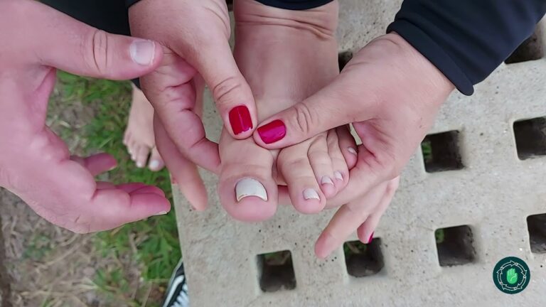 Tratamento eficaz para fratura do 1º metatarso