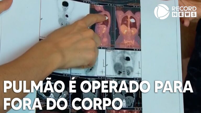 Custo da cirurgia de pulmão: o que esperar