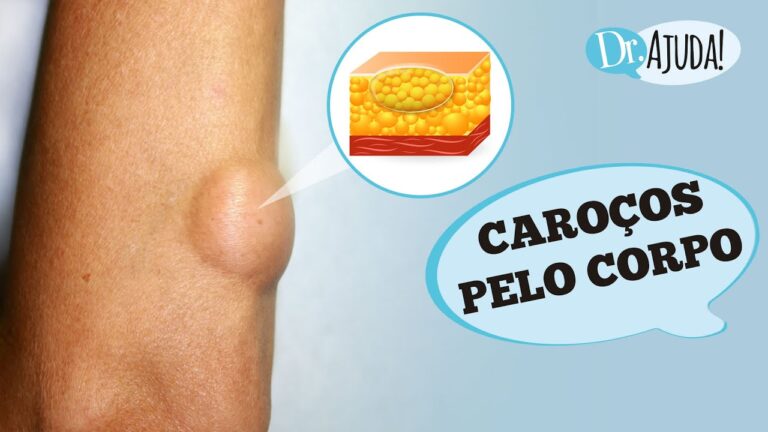 Como tratar um caroço no ombro esquerdo