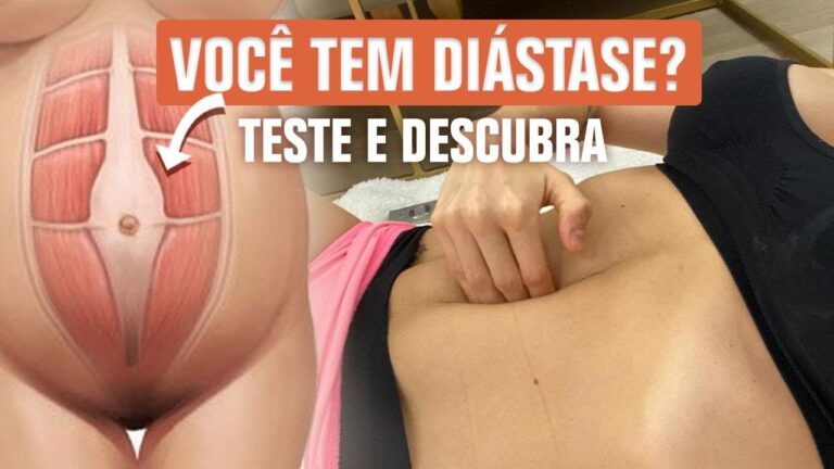 Fotos da Diástase Abdominal: Guia Completo