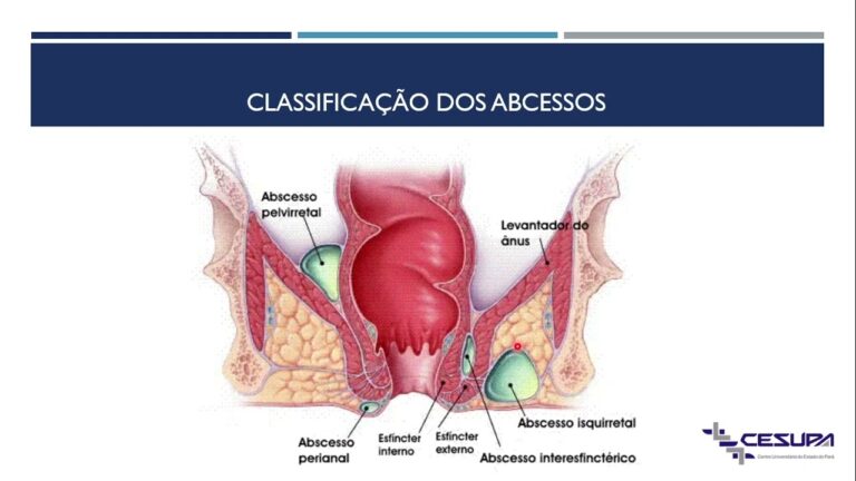 Tratamento eficaz de abscessos anais: guia completo