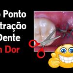 N&oacute;dulo n&atilde;o calcificado no pulm&atilde;o: diagn&oacute;stico e tratamento