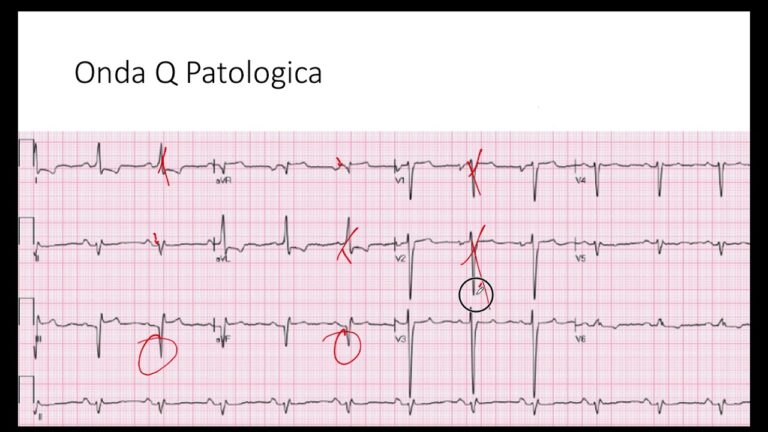 Ondas Patol&oacute;gicas: Um Estudo Abrangente