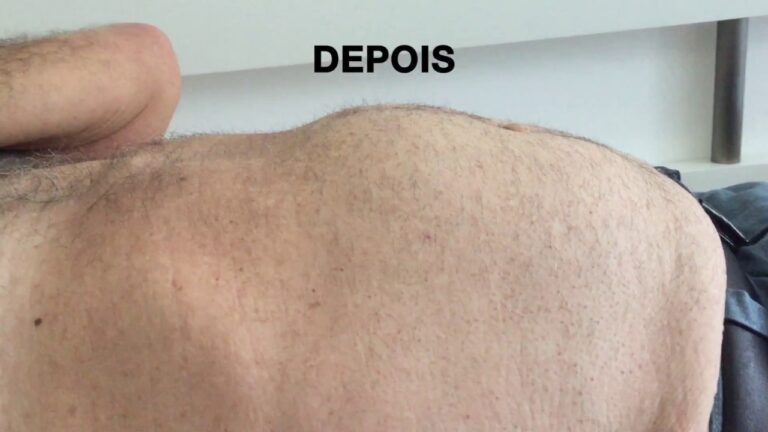 Alternativas eficazes para cirurgia de hérnia na barriga